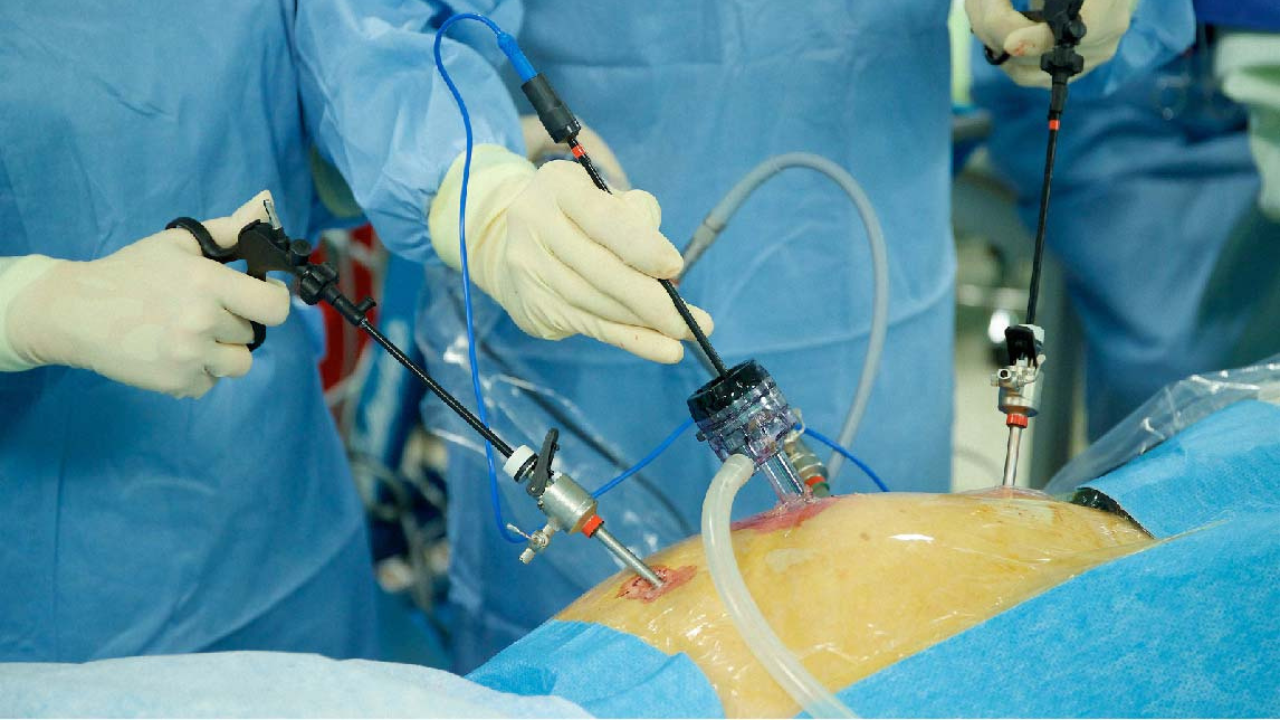 Laparoscopic Cancer Surgery: A Minimally Invasive Breakthrough in Oncologic Care