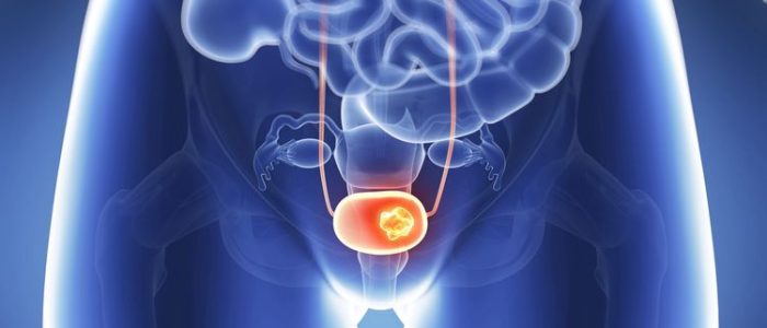 bladder cancer