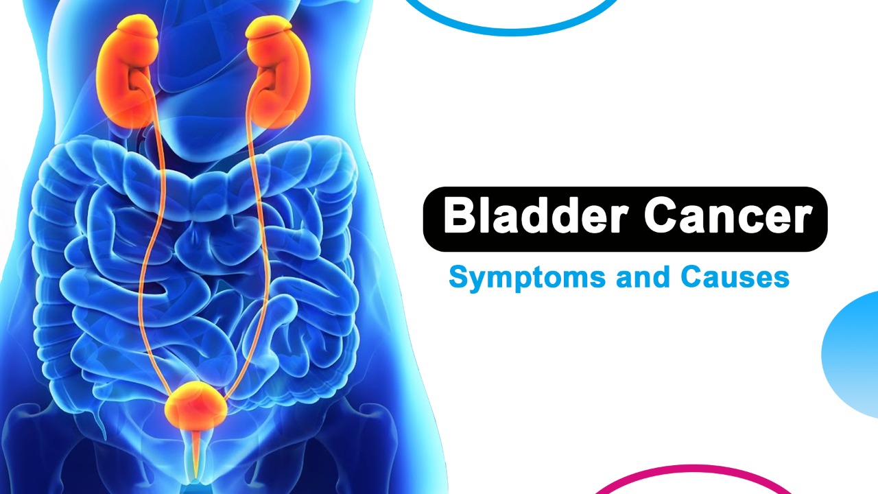 What are the Symptoms and Causes of Bladder Cancer?