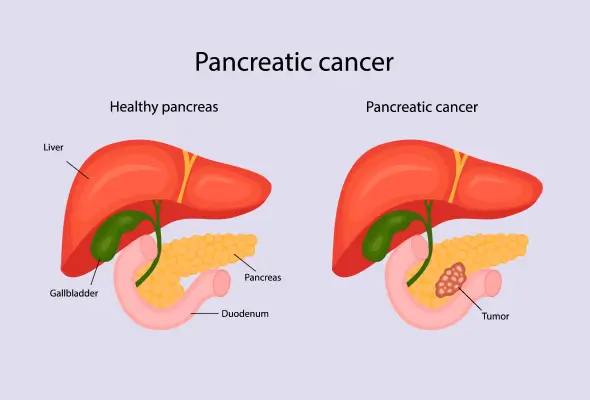pancreatic cancer